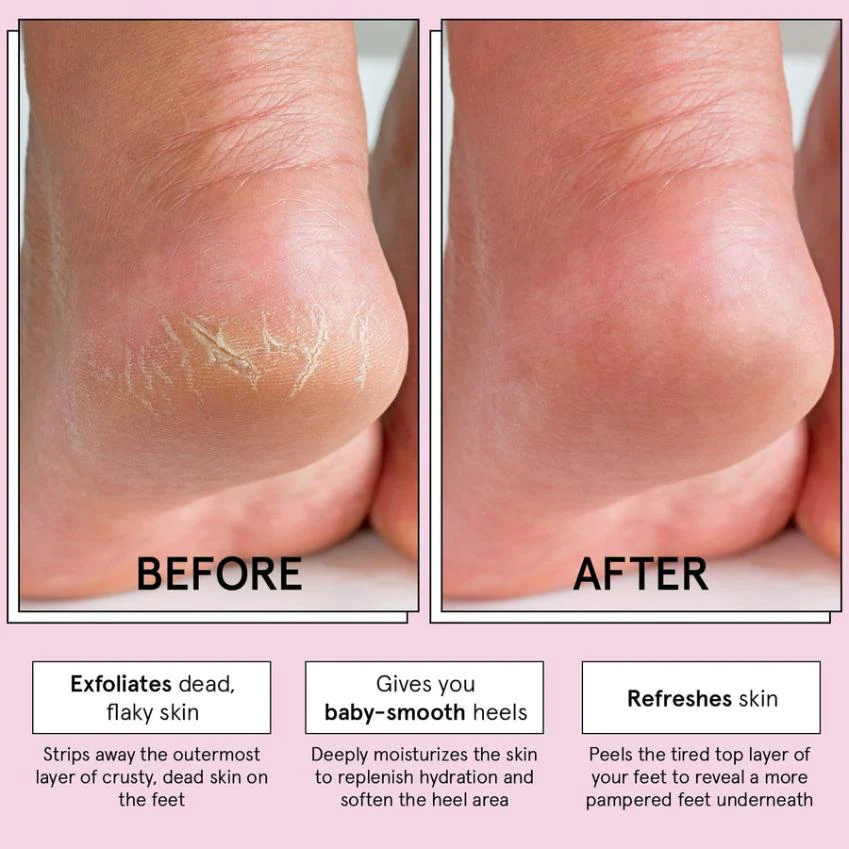 exfoliating foot peel mask - Image 4