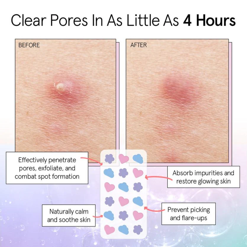 hydrocolloid pimple patches - Image 3